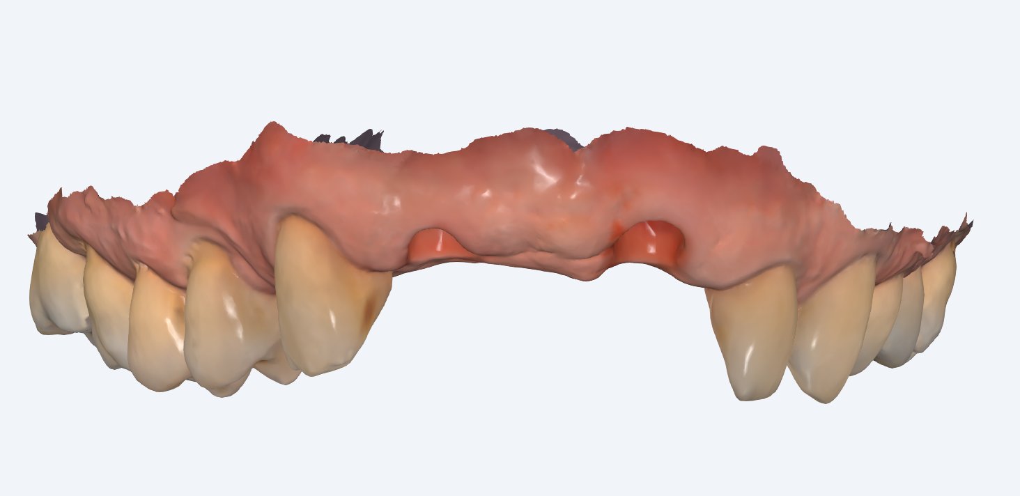 Implantater åbnet scanning set forfra - Tandlæge Morten Skov Hansen 3D-scanning af kæben efter at de to implantater er åbnet