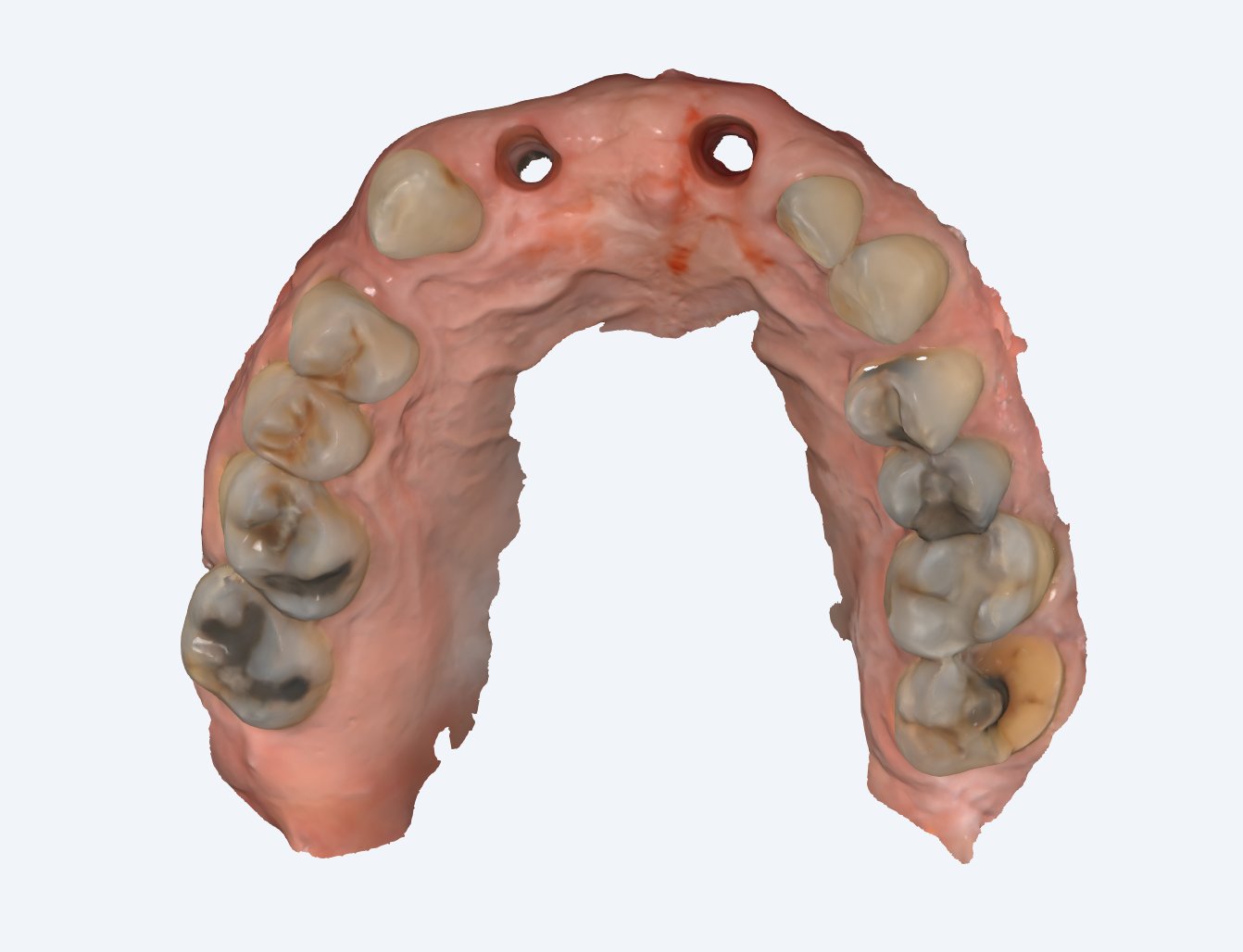 Implantater åbnet scanning set ovenfra - Tandlæge Morten Skov Hansen 3D-scanning set ovenfra med de to åbninger til implantaterne