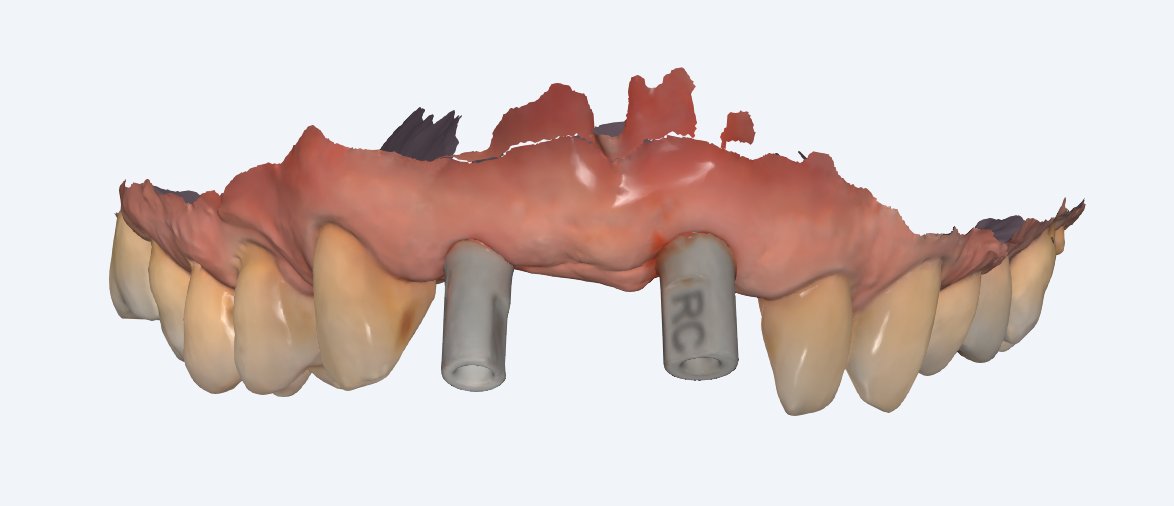 Scanning med scanpinde på implantaterne - Tandlæge Morten Skov Hansen 3D-scanning med scanpinde skruet på de to implantater